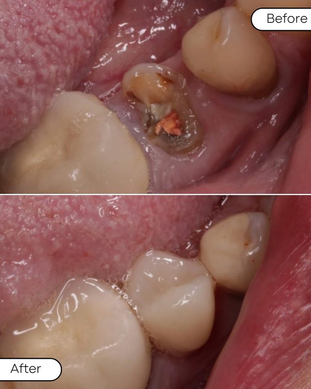 Before and after composite restoration