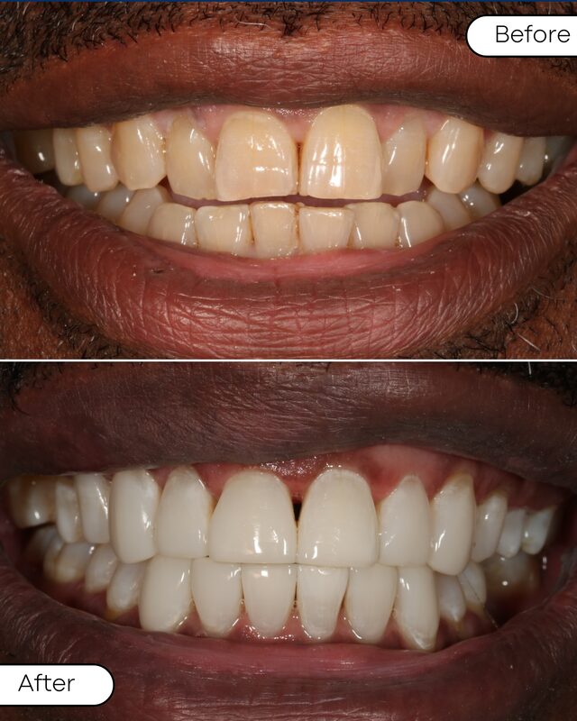 Before and after dental restoration